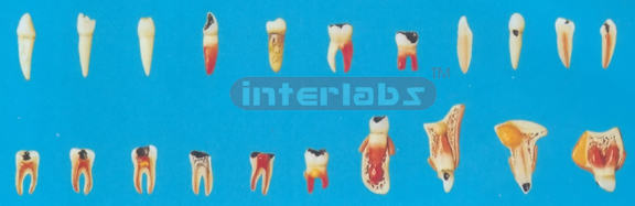 TEETH PATHOLOGIC MODEL CASE OF TEETH ODONTOPATHIES